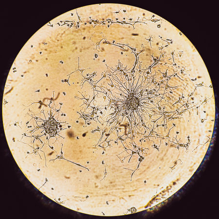 Glioblastoma cell spheroids. Forming spheroid of brain tumor cells under a microscope.の写真素材