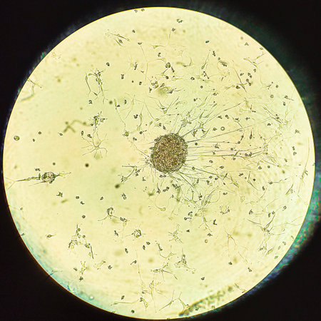 Glioblastoma cell spheroids. Forming spheroid of brain tumor cells under a microscope.