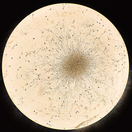 Glioblastoma cell spheroids. Forming spheroid of brain tumor cells under a microscope.