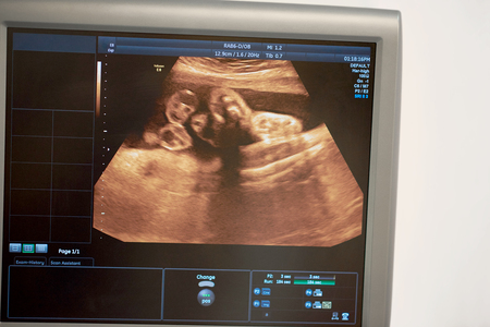 Pregnancy sonogram x-ray on a monitor of ultrasound scanner
