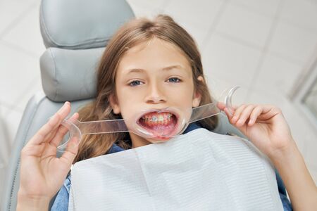 Close up of bold young girl holding mouth retractor. Beautiful patient sitting in dental chair with opening mouth and dental white bib, looking at camera.の写真素材