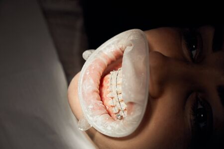 Close up of female face of patient of dental cabinet. Girl witn opening mouth looking up. Using metallic braces for alignment of teeth. For hygiene and ease of use mouth retractor.の写真素材