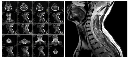 Magnetic resonance imaging of the cervical spine. MRI vertebral discs in different viewsの素材 [FY31059586847]