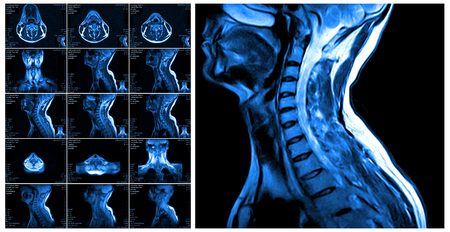 Magnetic resonance imaging of the cervical spine. MRI vertebral discs in different viewsの写真素材