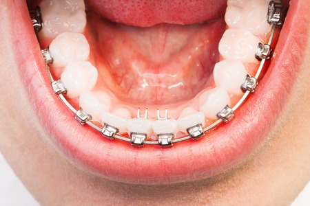 Mans lower jaw bone with dental braces on teethの写真素材