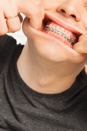 Young man with orthodontic cases having fun