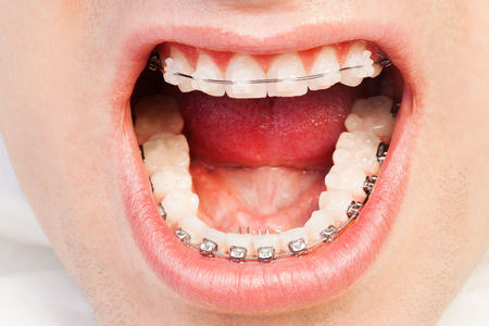 Wide opened mouth with self-ligating bracketsの写真素材