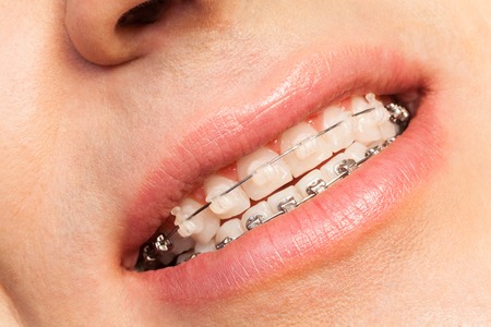 Man smiling showing dental braces