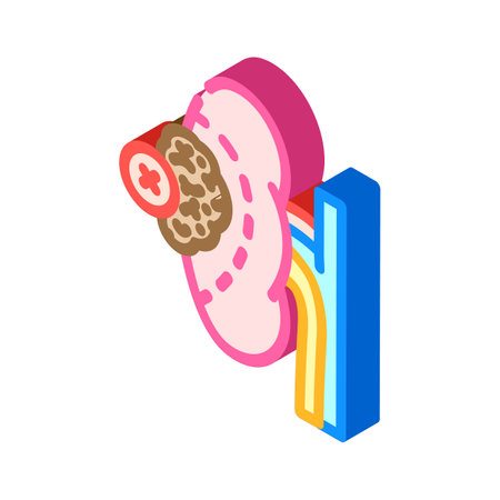 nephrectomy surgery isometric icon vector illustrationのイラスト素材