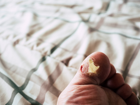 Close up of toe skin peeling with some blood.の写真素材