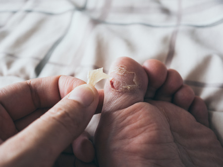 Close up of toe skin peeling with some blood.