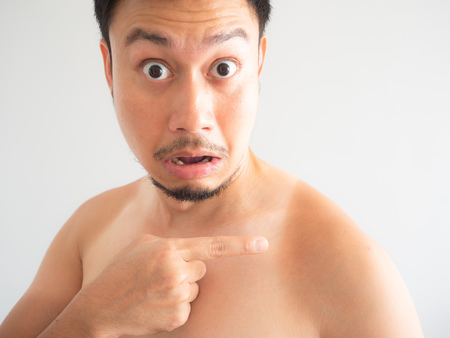 Shock face of Asian man get ugly tanned on the shoulder.の写真素材