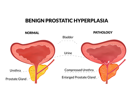 Benign prostatic hyperplasia is an non lethal pathology with timely treatmentのイラスト素材