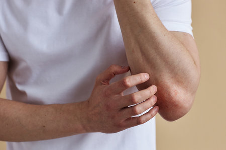 Close up of man scratching elbow suffering from rash or skin condition, copy space