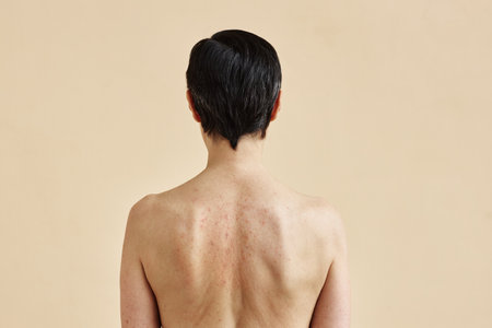 Minimal rear view of adult woman with rash spots on bare back standing against beige background, copy spaceの写真素材