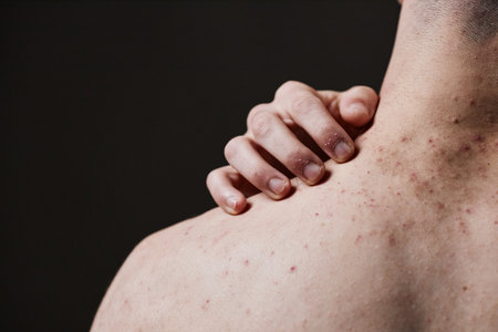 Young adult man showing back with visible acne and blemishes, hand touching shoulder, demonstrating skin conditionの写真素材