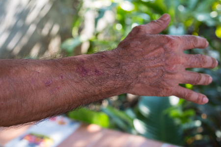 arm of old man who have rash because skin allergyの写真素材