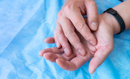 Psoriasis on the hands of a man. Dry male hand on a blue background. Hike to the doctor, treatment of eczema and psoriasisの写真素材