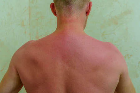 Skin on back of man got sunburn during sunbathing and become painful redの写真素材
