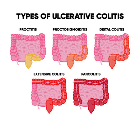 Ulcerative colitis types infographics including proctitis distal colitis pancolitis proctosigmoiditis subtotal colitis realistic. Human internal organ, anatomy, medicine concept, healthcare.のイラスト素材