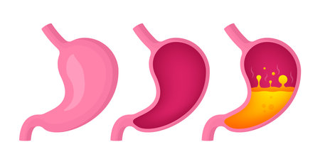 Stomach collection in different state. Healthy and unhealthy, empty and full human stomach. Nutrition, stomach pain, bloating, gastrite. Digestive system anatomy. Vector illustration.のイラスト素材