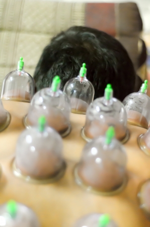 Cupping or Bekam Hijamah is traditional treatmentの写真素材