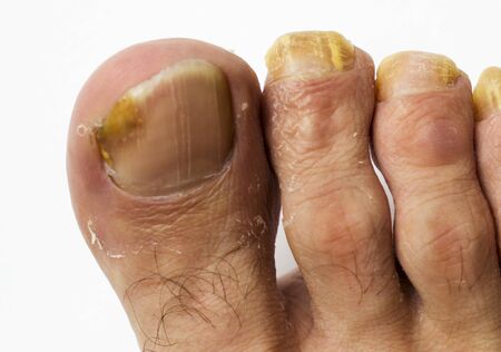 Close up fungus on the nails of a man's foot on a white background