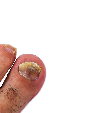Close up fungus on the nails of a mans foot on a white background.の写真素材