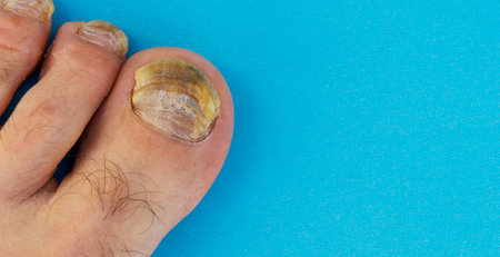 Close-up of all male foot thumbnail, fungal nail in blue background