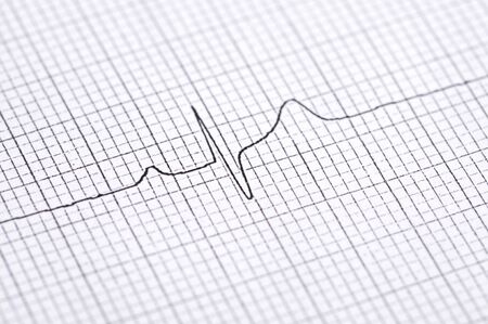 Closeup of twelve lead electrocardiogram graph showing ventrical activation time and amplitude