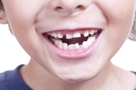 Closeup of young child smiling and showing his loose crooked baby teeth