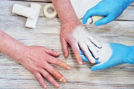 the doctor puts a bandage with the medicine on the burn of the fingers of the woman's hand, an accident at home, careless behavior with boiling water, an injured hand.の写真素材