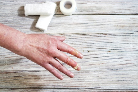 Woman puts scalded hand into cold water, burns of skin, injuries with boiling water, home accident, careless behavior with boiling water, steam, scalds on a skin, injured handの写真素材