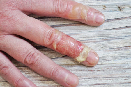 Woman puts scalded hand into cold water, burns of skin, injuries with boiling water, home accident, careless behavior with boiling water, steam, scalds on a skin, injured handの写真素材