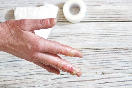 woman with a burn of the skin and fingers, injuries with boiling water, an accident at home, careless behavior with boiling water, steam, scales on the skin, an injured hand, injured fingers of a womanの写真素材