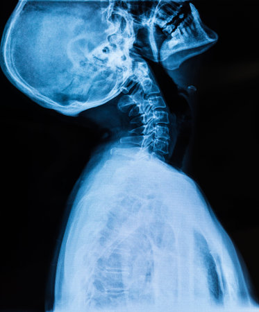Cervical X-ray film