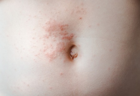 Chicken pox baby. The varicella zoster virus or scabies rash on the child. The concept of dermatology. Baby shows spots on his stomach. Close-up scratching. Allergy in childrenの写真素材