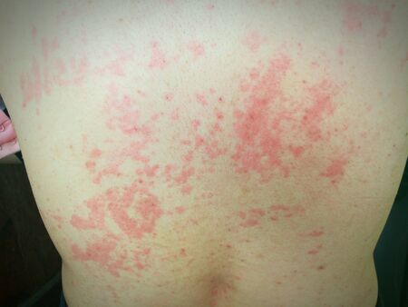 Poisonous Rash Toxic Burning sickness hospital timeの写真素材