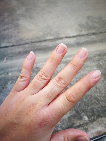 Forefinger Skin burns and swelling of inflammation from bee venomの写真素材