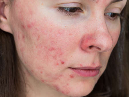 papulopustular rosacea, close-up of the patient's cheek - the consequences of prolonged wearing of a...