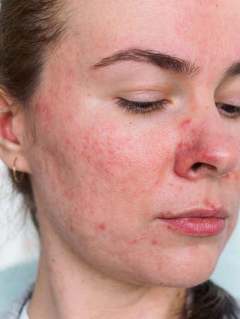 face of young woman with rosacea