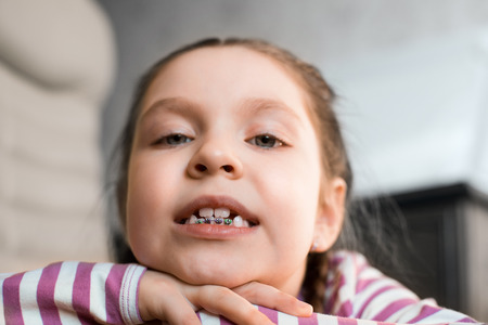 Close up portrait of Smiling girl showing dental braces.の写真素材