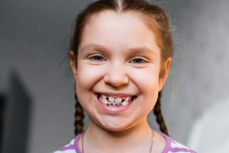 Close up portrait of Smiling girl showing dental braces.