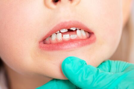 emonstration of front teeth growth in a five-year-old girl. Close-up.の写真素材