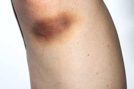 A Close Up of a Big Bruise on a Body Part Knee From Tripping UP and Falling Down