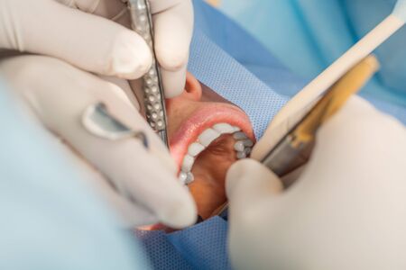 people, medicine, stomatology and dentistry concept - close up of patient face having teeth...