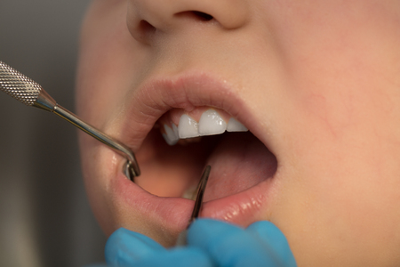 Woman teeth and a dentist mouth mirror. the dentist doing an inspection. Medical conceptの写真素材