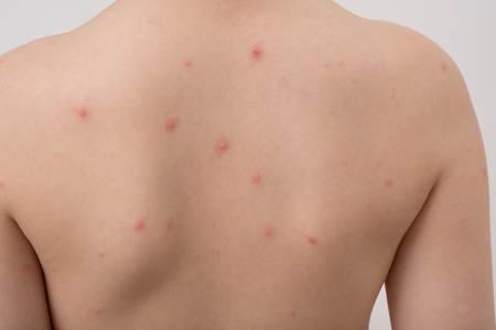 Closeup of back of boy with Varicella virus or Chickenpox.の写真素材
