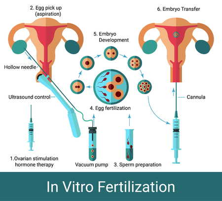 In vitro fertilization infographic chart. Flat style scheme of artificial fecundation. Uterus ultrasound. Egg insemination. Embryo development. EPS 10 vector illustration. Isolated.のイラスト素材