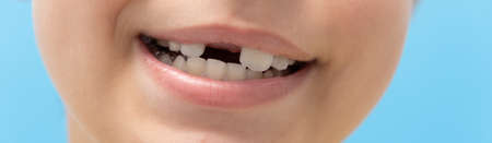smile without front tooth. close up photo.